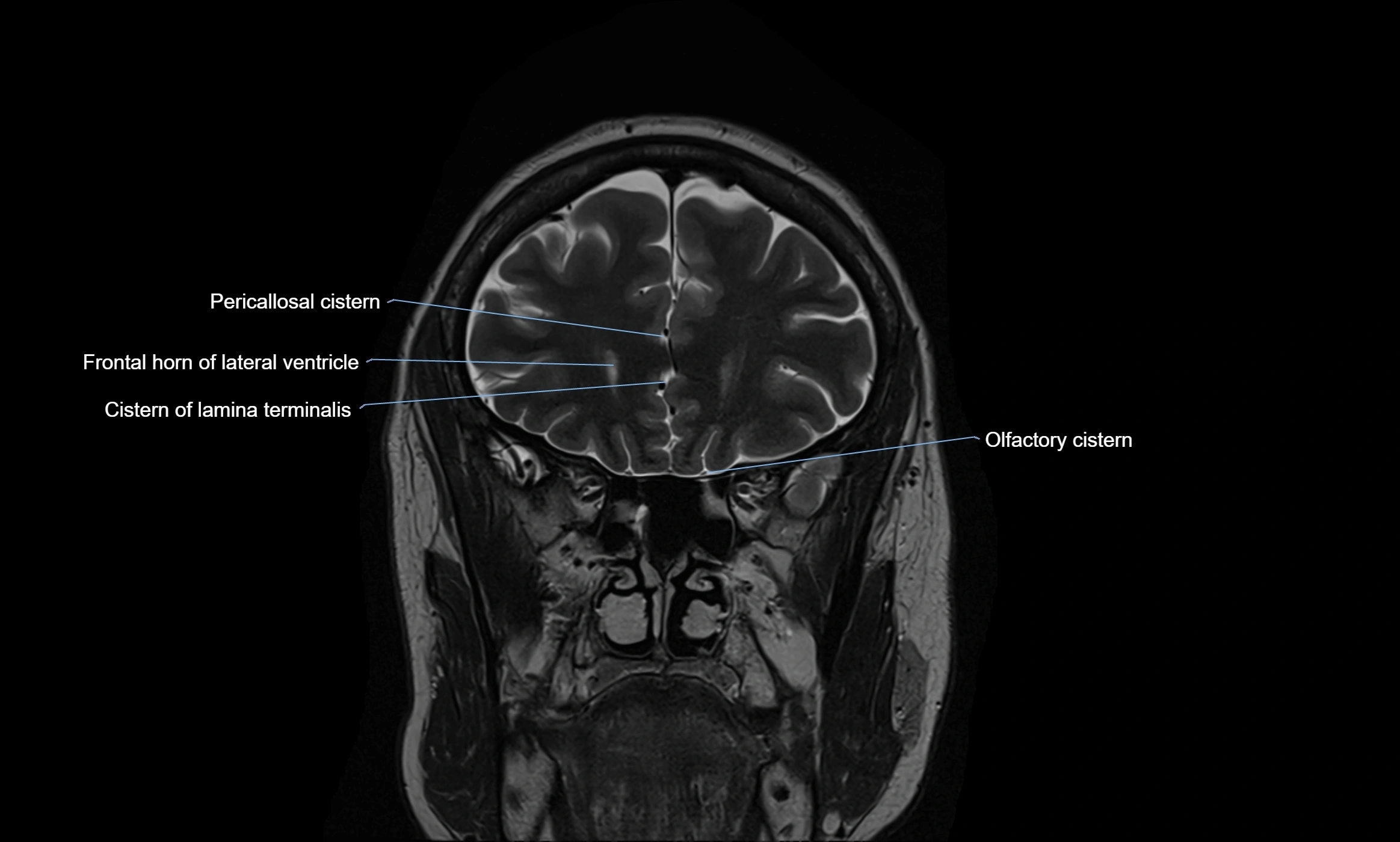 Brain cisterns  and ventricles coronal anatomy 3T MRI image-img-00001-00013.webp